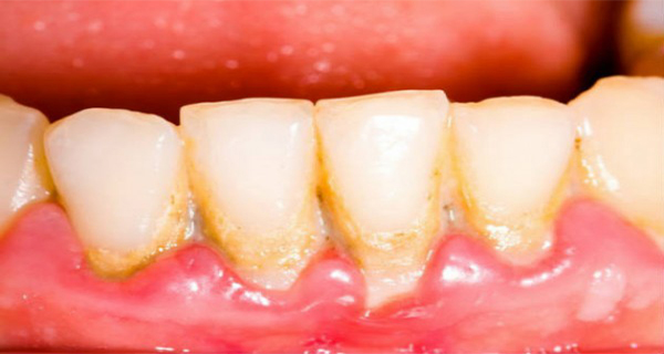 Remove the Dental Tartar Plaque and Destroy the Bacteria in Your Mouth with Only One Ingredient