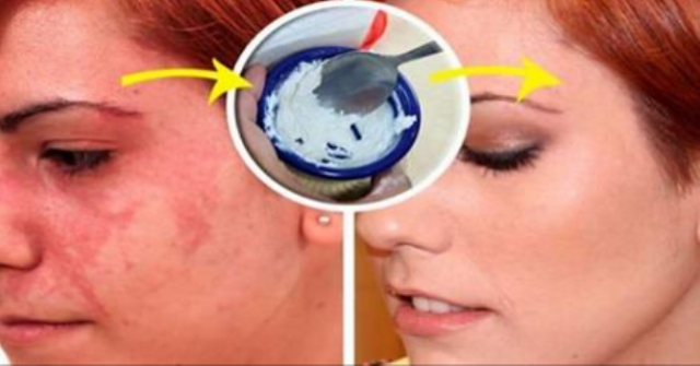 ONE INGREDIENT TO REMOVE THEM ALL HERE’S HOW TO SOLVE ALL YOUR SKIN PROBLEMS OVERNIGHT!