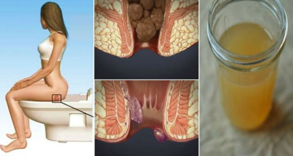 Treating Hemorrhoids at Home With One Ingredient From Your Kitchen You Will be Cured in 24 Hours !
